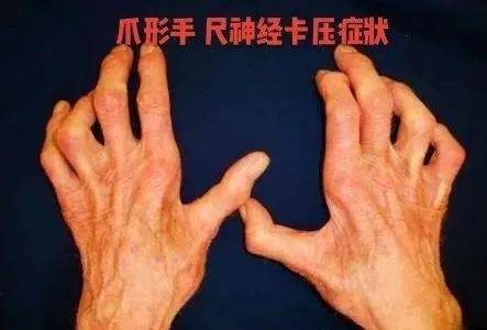 手掌木命是什么意思？手掌麻木是由什么原因引起的？如何缓解手掌麻木症状？