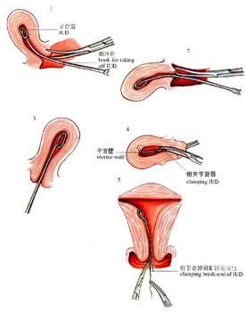坠胀感持续不断