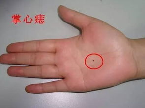 小腿上有鳞纹或十大吉痣，这是吉是凶？