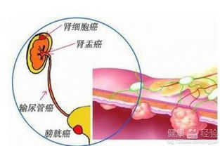 如guo泌尿系统有肿瘤会有什么症状,风水泌尿系统怎么破
