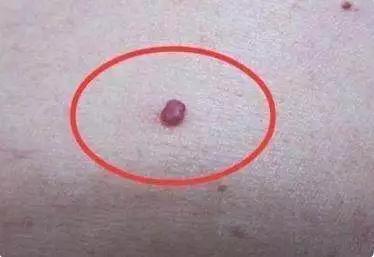 如何正确对待身上的“痣