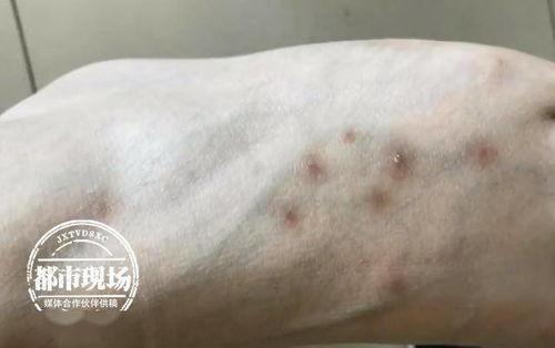 梦见脸上被蚊子咬好多包是什么寓意？