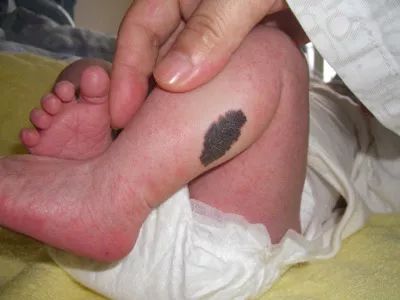 2026年胎记运势大预测