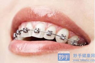 儿童牙齿不齐几岁可以矫正,儿童牙齿深度覆合一定要矫正吗