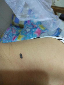 长在哪些部位或形状的痣更容易病变，需要注意观察吗？