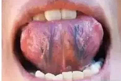 风水舌头翘的保养,舌头翘怎么调理