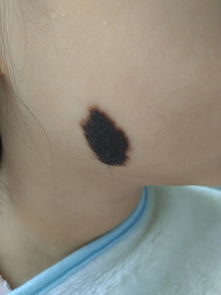 胎记：前世留下的神秘密码还是随机生成的皮肤BUG？