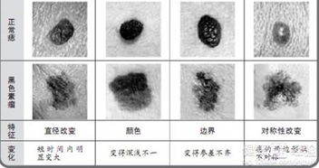 医学小知识—不是所有黑痣都是恶魔， 却也不是所有恶魔都是黑痣