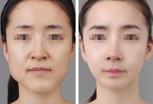 瓜子脸， 锥子脸的代名词