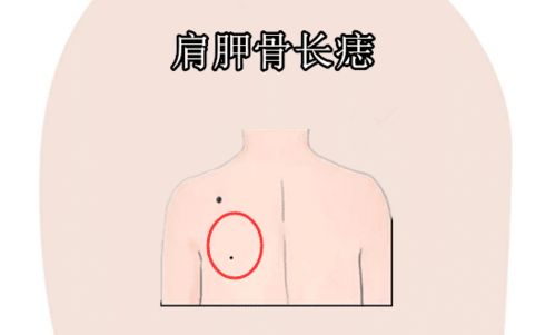 2. 颧骨上的点点——颧骨有痣是福星?