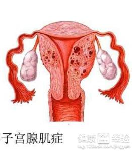 别慌！先搞清楚子宫糜烂到底是个啥玩意儿