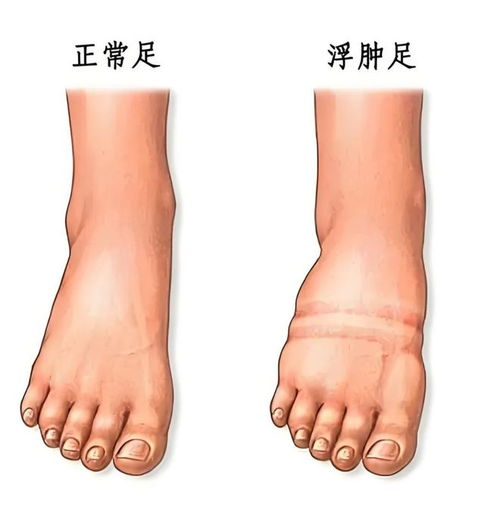 痛风水肿如何按摩消肿,痛风水肿如何按摩