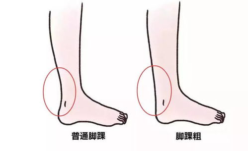 五、 脚踝粗身体健康 根基不稳万事皆休