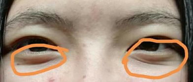 眼睛下方八字线纹是侧睡压出来的吗？