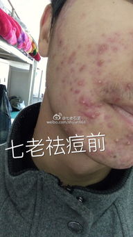 三、风水玄学能治湿疹？笑死！