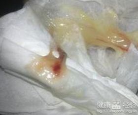第一道防线崩塌：阴道生态系统失衡