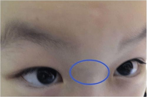 免疫力低下？印堂先报警！