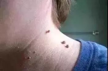 前面的痣：钱包漏了个洞