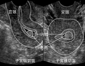 3. 子宫内膜息肉——较小怪兽潜伏记！