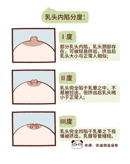 先天性乳头内陷的类型划分（看完你懂了吗？）