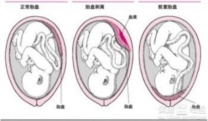 胎盘对风水有影响吗？其原理是什么？