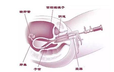 第一一部分：别盲目做宫腔镜！先看看你符合这5个条件吗？