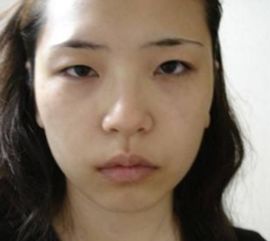 嘴巴较小而无口角