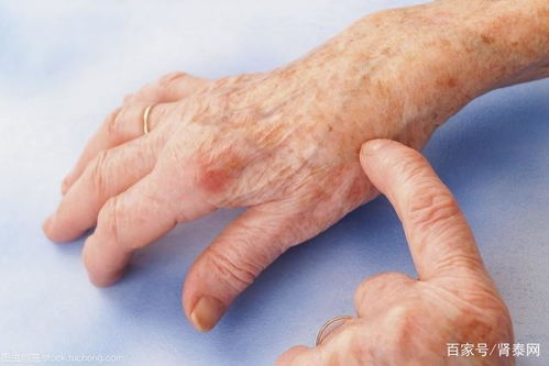 跳跳鱼治痛风水肿,跳跳鱼吃了有什么好处