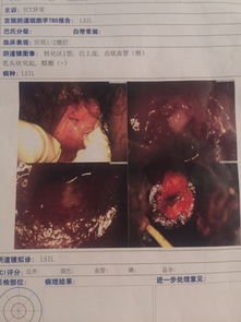 1.1 卵巢更多囊到底是啥