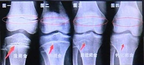 1.2 激素型IUD：你以为它比铜线更靠谱吗？