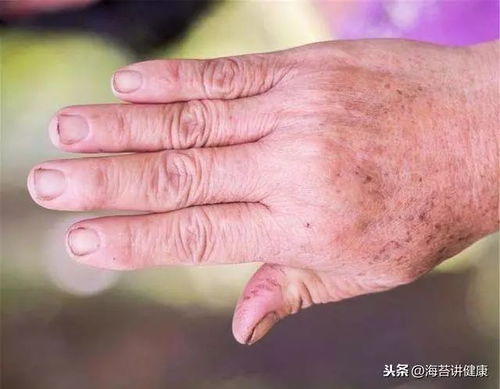 梦到手上长毛是什么征兆或含义？