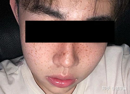 40岁男性手背长斑会影响面相吗？