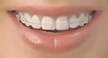 矫正牙齿期间如何避免佩戴牙套时发生龋齿？