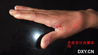 虎口有疤痕究竟预示着怎样的命运，特别是对女性而言？