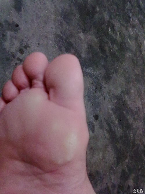脚底长类似水泡又痒的疙瘩是什么原因引起的？