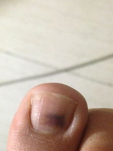 左右脚大拇指指甲有黑块，分别代表什么命运？