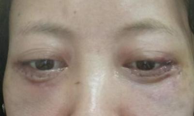 面相眼袋大手术20天恢复效果如何？吉凶图解读？
