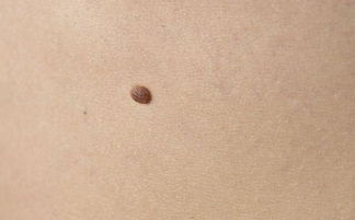 祛痣方法大比拼