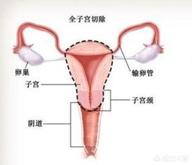 罕见但致命：子宫穿孔事故