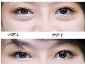 面相眼袋大手术20天恢复效果如何？吉凶图解读？