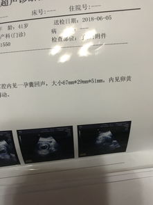 二、孕囊30天真的有多小？（顺便给它取个名字）