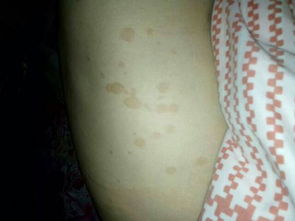 天生后背有红色印记风水,后背上出现红色印记