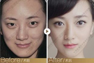 我国双眼皮和单眼皮人口比例，哪个更多呢？
