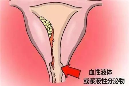 一、功能性子宫出血——神秘的“二次来访”