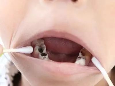 一、周末特惠，蛀牙患者福音