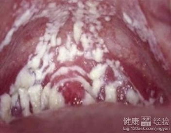 1）霉菌性阴道炎——最常见的“豆腐渣”主角