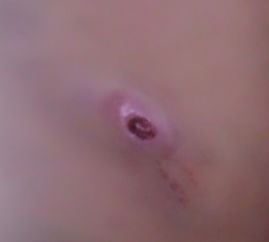 头上长火疖子是风水有问题吗,头上长了火疖子特bie疼