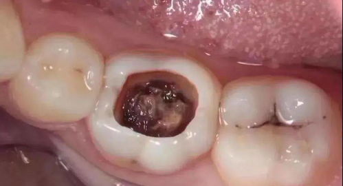 长重牙人命运如何？拔掉重牙是必须的吗？