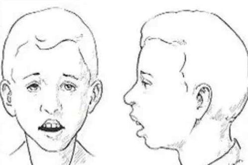 特殊鼻型：猪胆鼻与狮子鼻