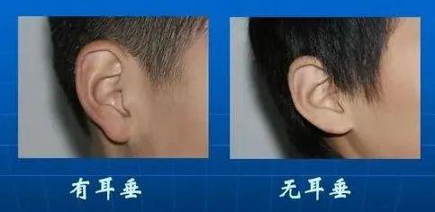 耳垂和健康的关系？医生看了想打人